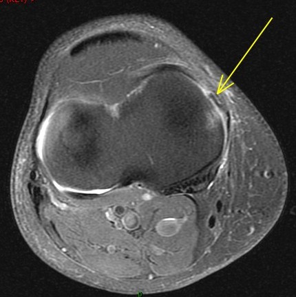 Figure 5 for case Unstable flap tear medial meniscus